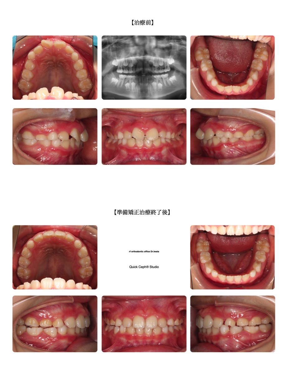 叢生症例　＜上顎前突を伴う叢生に対する準備矯正治療＞