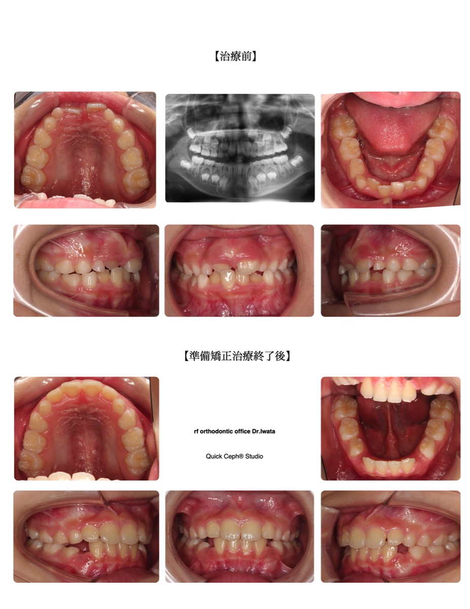 反対咬合症例　＜叢生を伴う反対咬合に対する準備矯正治療＞