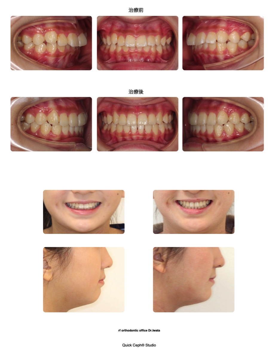 上顎前突症例 　＜過蓋咬合を伴う前歯の前突を改善した非抜歯矯正治療＞