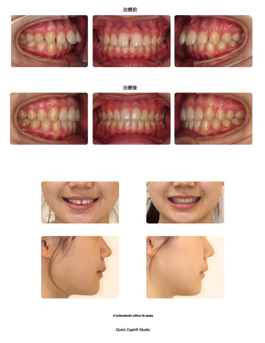空隙歯列症例 ＜過蓋咬合および正中離開を伴う空隙歯列に対する非抜歯矯正治療＞