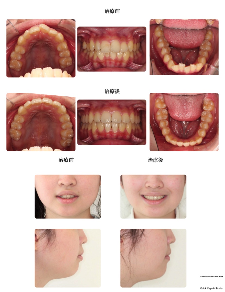 叢生症例　＜上下顎前歯部叢生に対する非抜歯矯正治療＞