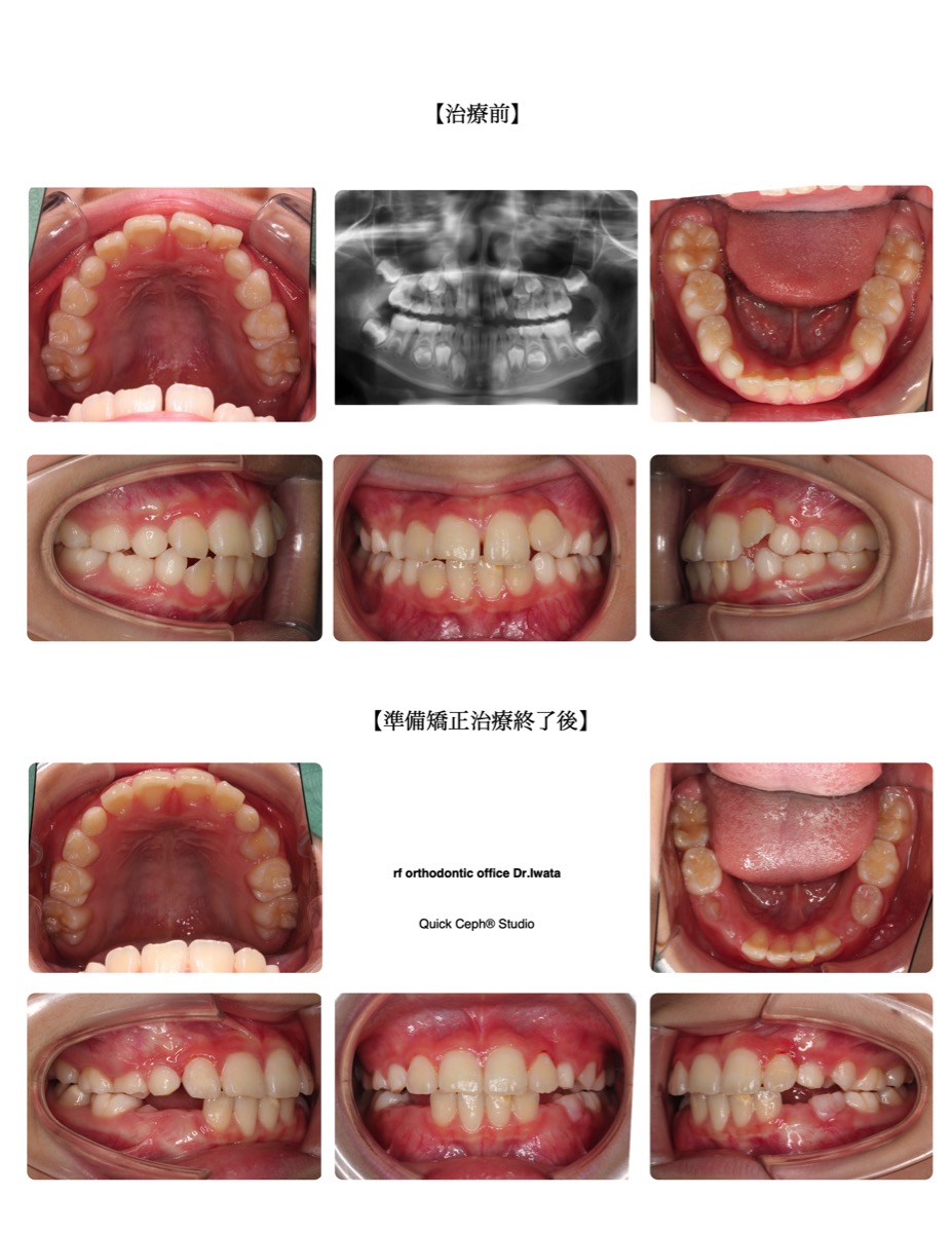 叢生症例　＜正中離開を伴う上顎前歯叢生に対する準備矯正治療＞