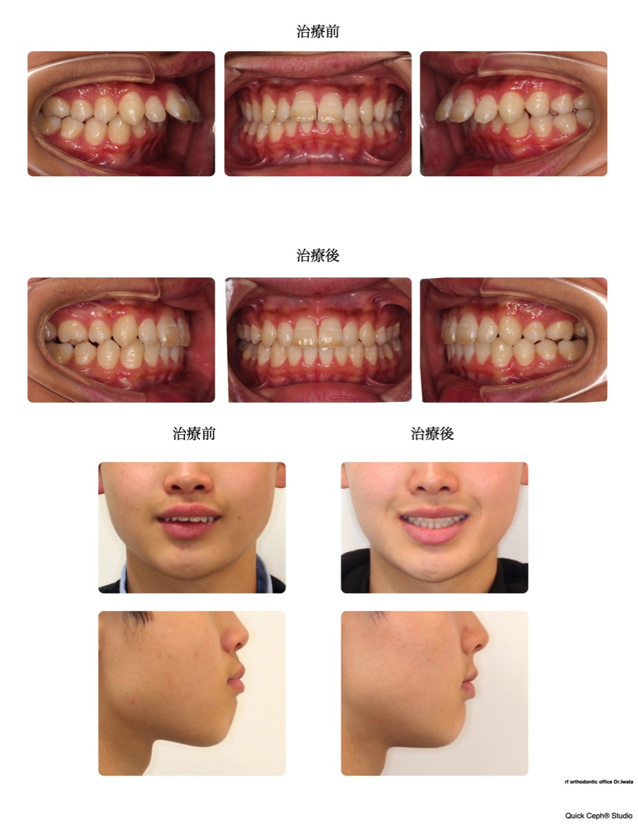上顎前突症例 　＜正中離開を伴う上顎前突に対する抜歯矯正治療＞