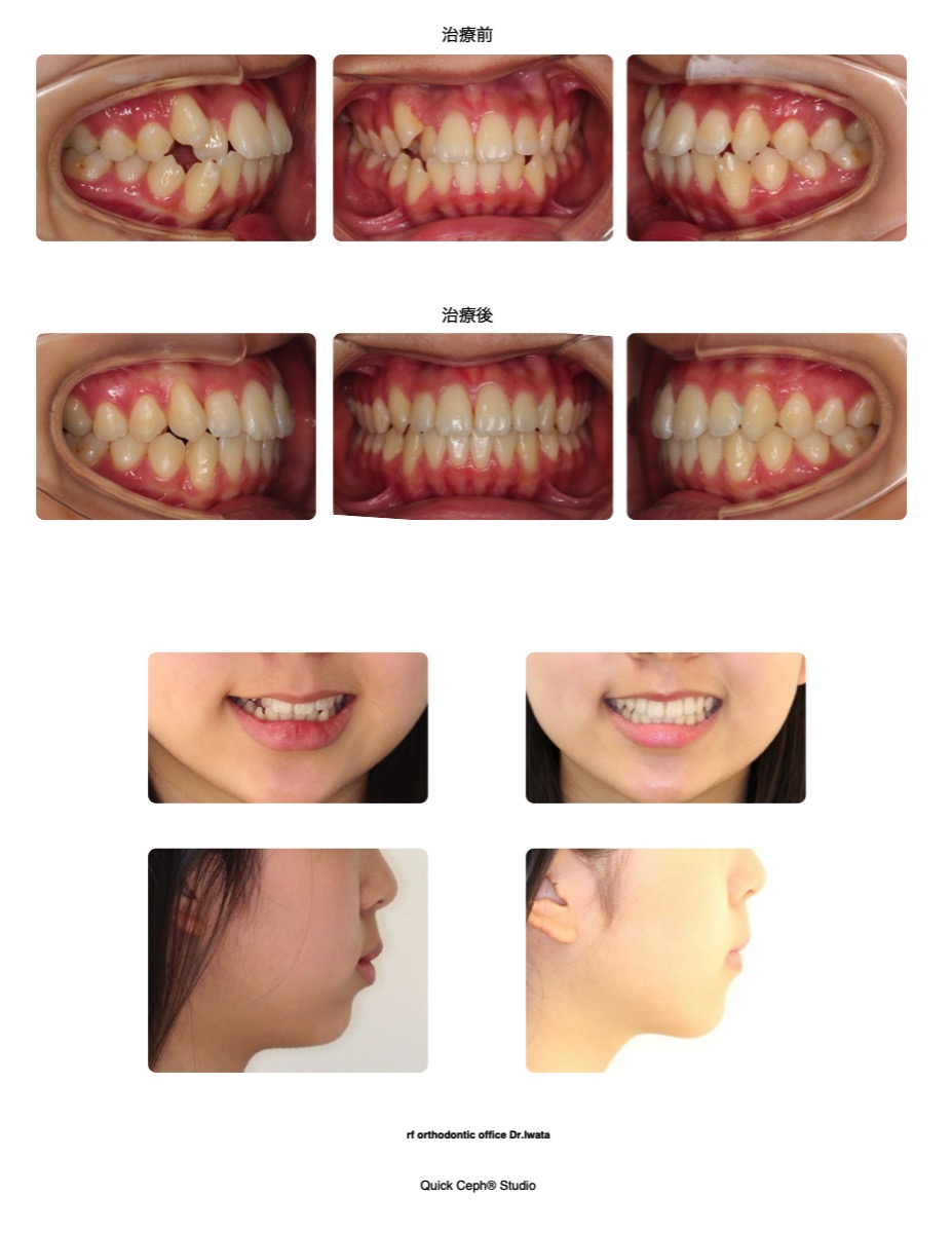 叢生症例　＜八重歯を伴う上下顎叢生に対する非抜歯矯正治療＞