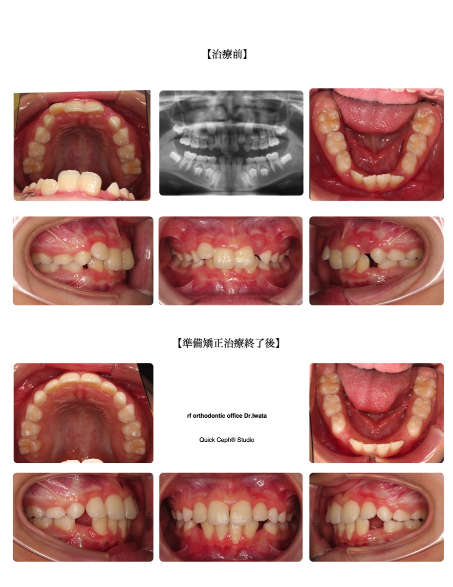 過蓋咬合症例　＜叢生を伴う過蓋咬合に対する準備矯正治療＞