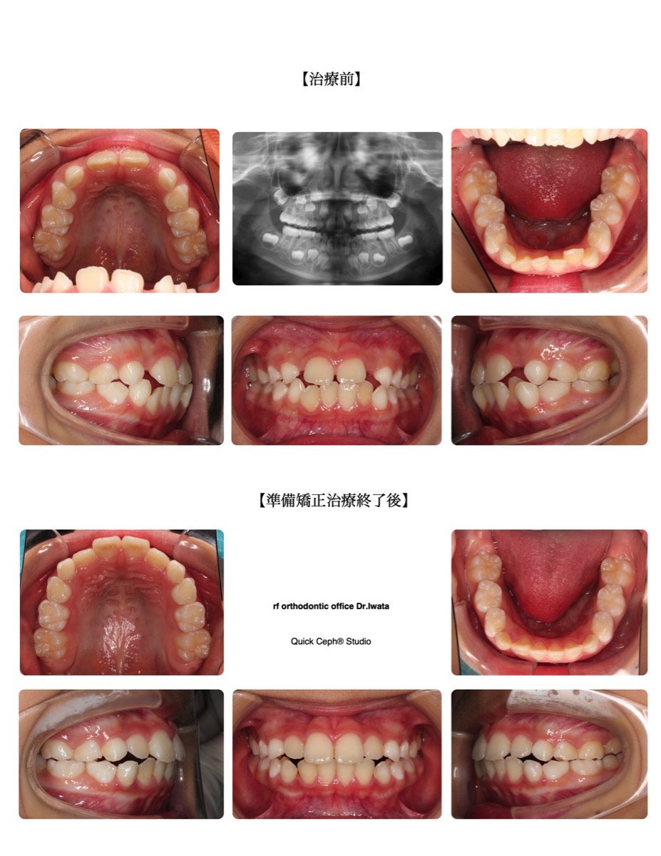 叢生症例　＜切端咬合を伴う叢生に対する準備矯正治療＞